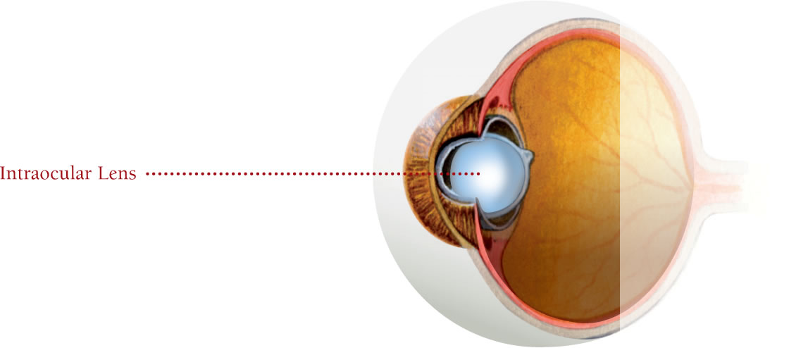 Intraocular Lens diagram