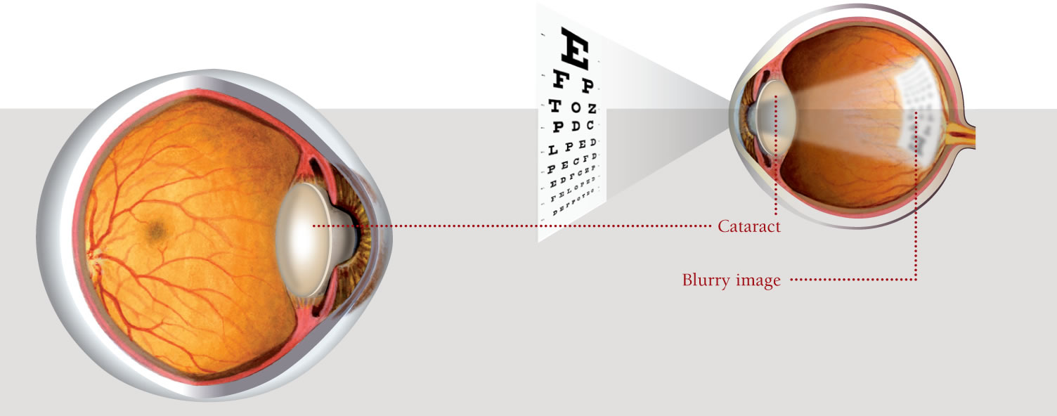 Cataract diagram